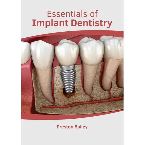 Essentials of Implant Dentistry