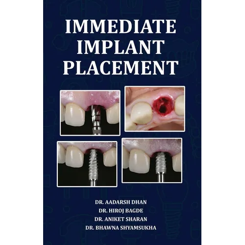Immediate Implant Placement