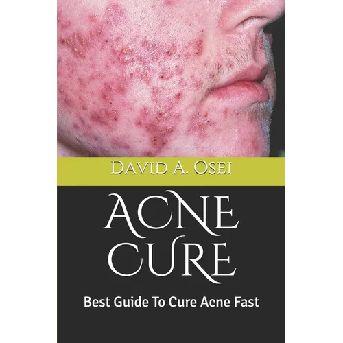Acne Cure: Best Guide To Cure Acne Fast