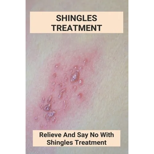 Shingles Treatment: Relieve And Say No With Shingles Treatment: Shingles On Face Treatment